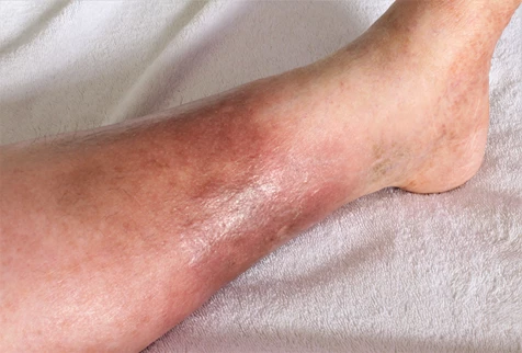 a swollen, red lower leg caused by a blood clot or deep vein thrombosis.